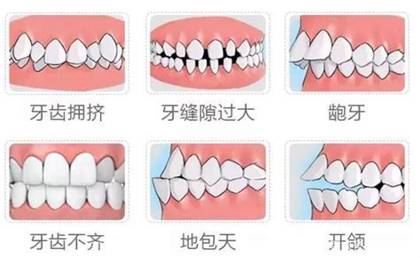 大门牙|门牙大怎么办